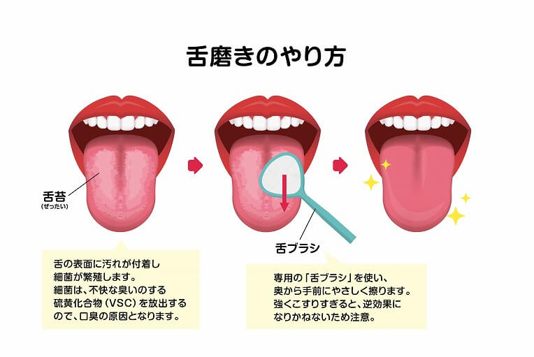 舌苔の清掃
