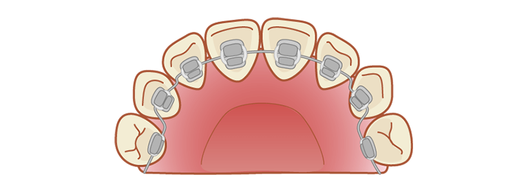 裏側矯正（舌側矯正）