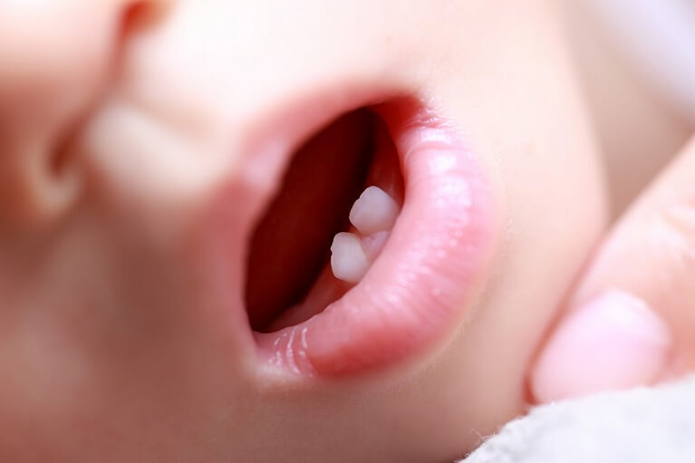 子供の歯は生え変わりがあるけど矯正治療は必要？