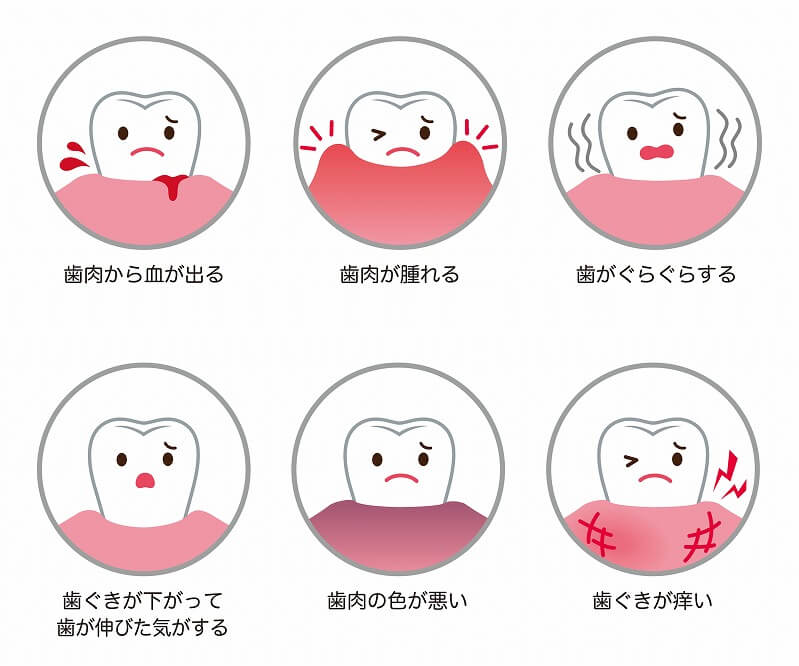 歯周病の症状をセルフチェック