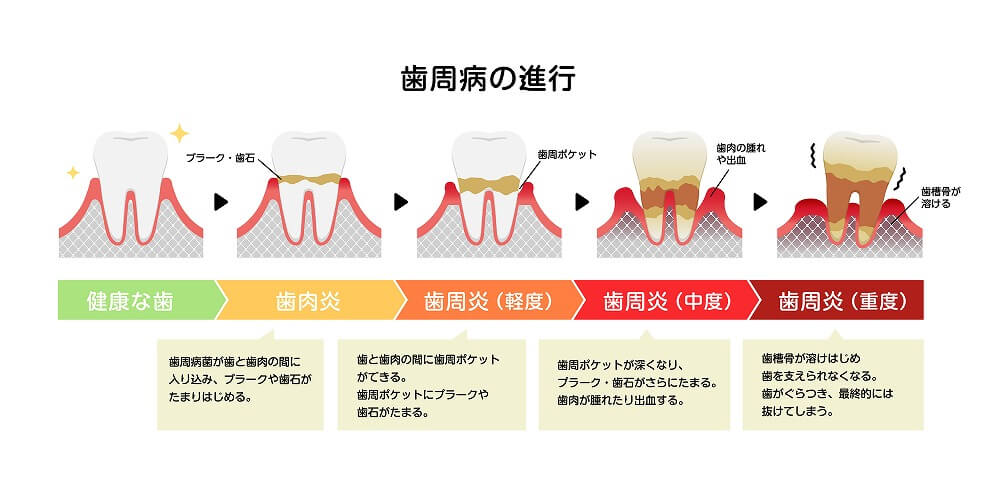 歯周病を引き起こす原因