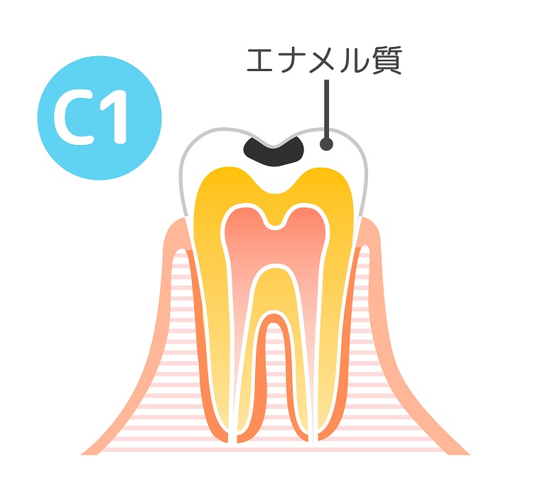 虫歯の治療