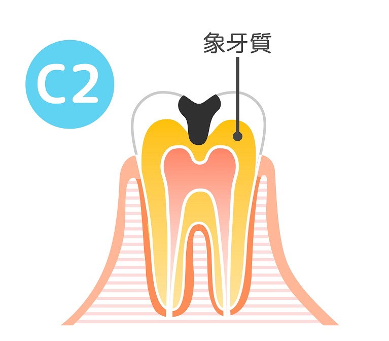 虫歯の治療