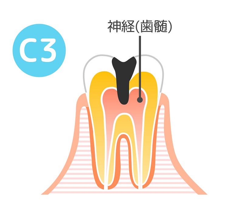 虫歯の治療